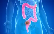 Phát hiện yếu tố làm tăng nguy cơ ung thư đại tràng ở người trẻ