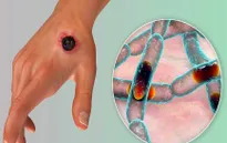 Thái Lan ghi nhận ca tử vong đầu tiên do bệnh than sau 30 năm, cảnh báo không thể chủ quan!