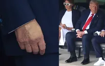 Nhà Trắng lên tiếng về căn bệnh mãn tính khiến ông Trump bị sưng chân và bầm tím tay