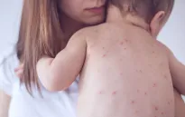 Tỷ lệ tiêm chủng suy giảm, số ca mắc sởi tại châu Âu và Trung Á tăng mạnh