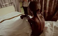 Phương Tây cắt giảm viện trợ có thể khiến hơn 22 triệu người tử vong