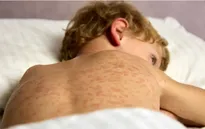 Dịch sởi bùng phát tại Mỹ 
