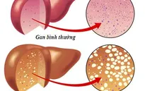 Dùng thuốc gì khi gan bị nhiễm mỡ?