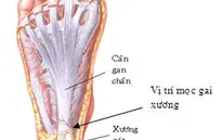 Không nên đi lại nhiều khi bị gai xương bàn chân