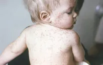 Mỹ: Số ca mắc sởi cao nhất trong vòng 18 năm