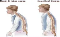 Phát hiện và phòng ngừa bệnh loãng xương ở phụ nữ