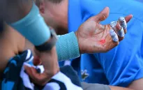 Australian Open: Tay Nadal bật máu trong trận thắng Dimitrov