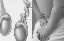 Khối căng phồng vùng bẹn - nguy hiểm ẩn chứa