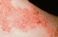 Phòng ngừa các biến chứng của Zona lên bệnh lý tim mạch