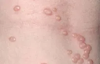 Nam thanh niên mắc u mềm lây do quan hệ tình dục không an toàn