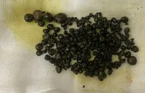 Gần 400 viên sỏi "chen chúc" trong túi mật nữ bệnh nhân 47 tuổi