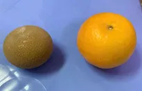 Lấy sỏi bàng quang to như quả cam khỏi cơ thể người đàn ông 69 tuổi