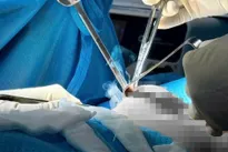 What is recurrent capsular contracture?