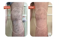 Foreign Tourist Recovers After Varicose Vein Treatment at Dr.Vein