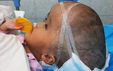 Trung Quốc: Bé gái bị não úng thủy đầu tiên trên thế giới được thay hộp sọ nhân tạo