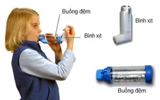 6 bước sử dụng bình xịt cắt cơn hen phế quản tại nhà