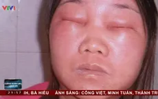 Sử dụng mỹ phẩm kém chất lượng, nạn nhân đối mặt với nỗi tuyệt vọng