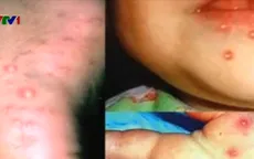Lâm Đồng: Một trẻ tử vong do bệnh tay chân miệng