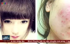 Nữ sinh viên bị nhiễm độc da, không được mang thai trong 1 năm vì hậu quả của mỹ phẩm