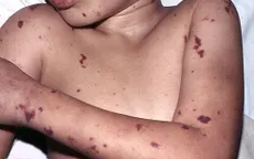 Những điều cần biết về bệnh viêm màng não mô cầu