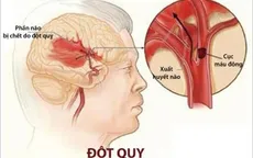 Phòng tránh bệnh đột quỵ như thế nào?