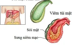 Đừng xem nhẹ bệnh viêm túi mật
