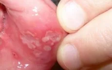 Phương pháp hữu hiệu chữa bệnh nhiệt miệng tại nhà
