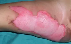 Cách sơ cứu đúng trong “thời gian vàng” khi bị bỏng