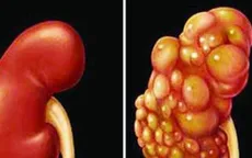 Ung thư thận có xu hướng gia tăng và ngày càng trẻ hóa