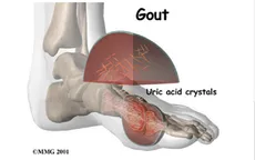 Vì sao bệnh gout bùng phát mạnh vào mùa xuân?