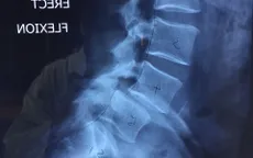 Phẫu thuật cột sống bằng robot cho bệnh nhân người Anh