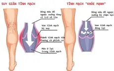 Suy tĩnh mạch mạn tính - bệnh không đơn giản