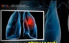 Phát hiện và điều trị sớm bệnh lao
