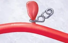 Phương pháp mới trong điều trị dự phòng phình mạch não