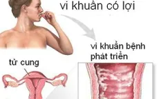 Viêm nhiễm phụ khoa và cách phòng tránh