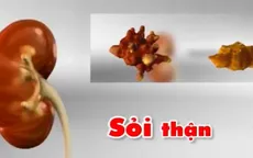 Những nguyên nhân gây bệnh sỏi thận?