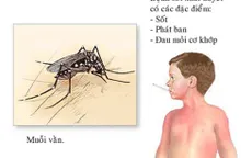 Hướng dẫn xử trí khi bị sốt xuất huyết
