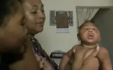Thêm bằng chứng virus Zika liên quan tới dị tật đầu nhỏ