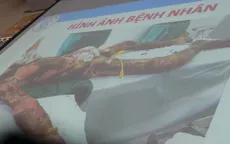 TPHCM: Cứu sống bệnh nhân bị bỏng nặng vì hút thuốc gần bình xăng