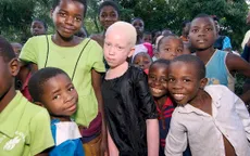 Người mắc bạch tạng ở Malawi có nguy cơ tuyệt chủng