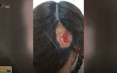 TP.HCM: 2 người bị bỏng sâu do uốn tóc, hấp dầu