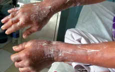 8 người bị bỏng nặng do sử dụng cồn nước