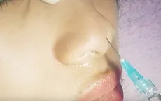 Tiêu điểm: Chất làm đầy thẩm mỹ filler - Làm đẹp hay gây họa?