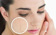Ai sở hữu làn da khô, hãy từ bỏ 6 thói quen gây hại này!