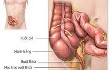 Bệnh viêm đại tràng co thắt dễ tái phát