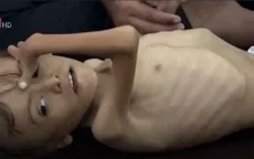Thế hệ trẻ em suy dinh dưỡng sau chiến tranh tại Yemen