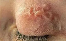 Phòng bệnh giun đũa từ chó, mèo