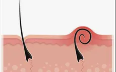 Thoát tình trạng lông mọc ngược chỉ trong một nốt nhạc với những mẹo sau đây