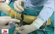 Những hiểu nhầm về phẫu thuật kéo dài chân