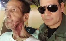 Từ một vết loét miệng, người đàn ông này đã bị "ăn" mất gần nửa khuôn mặt